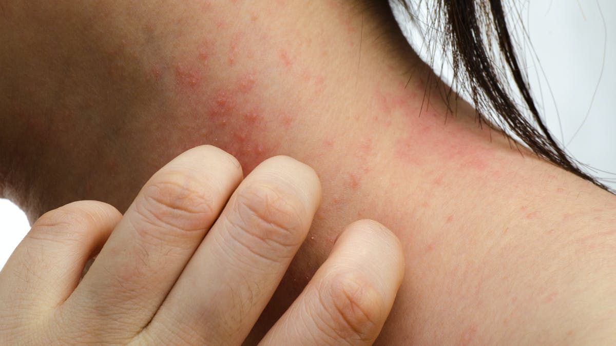 Cellulite inflammation des cellules